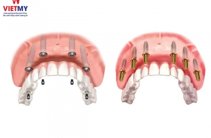 Trồng răng Implant All on 4, All on 6 - Giải pháp hoàn hảo cho người mất răng toàn hàm